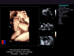 S2000 3D amnioscopic2